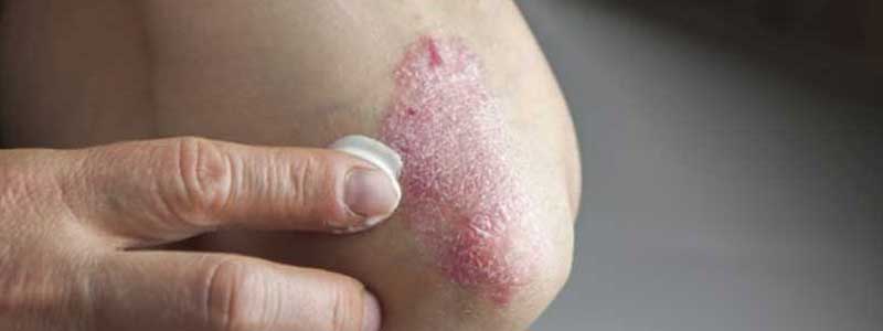 ayurveda treatment for psoriasis in bangalore