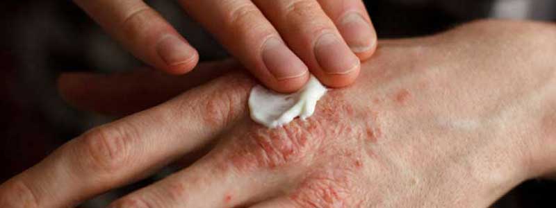 Ayurvedic treatment of psoriatic arthritis in Bangalore