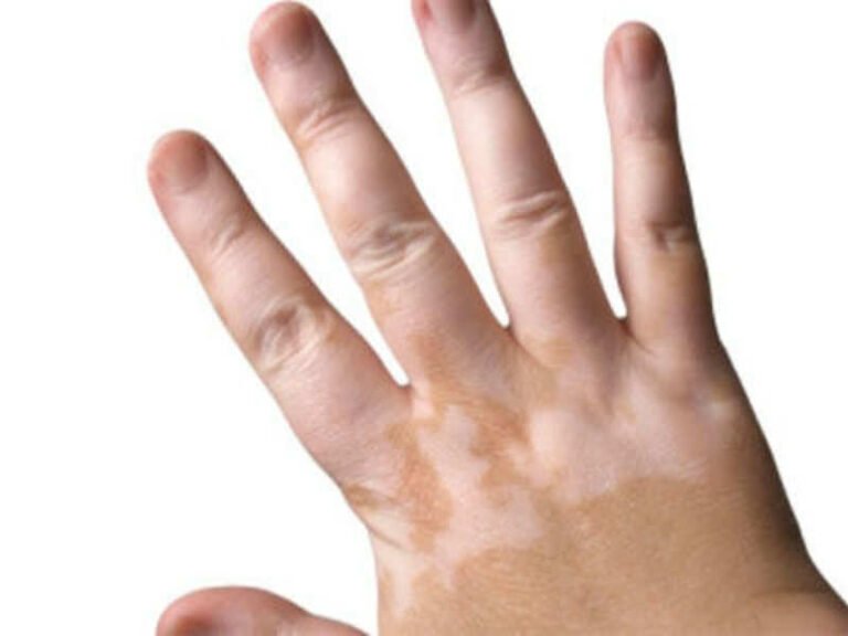 How Can We Treat Vitiligo (white patches) Through Ayurveda? – Dr.Mini Nair
