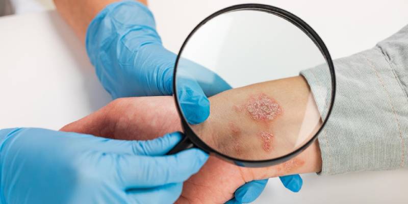 Best Ayurvedic Treatment for Fungal Infection: Effective Remedies