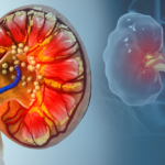 Best Ayurvedic Treatment for Kidney Stones Without Surgery