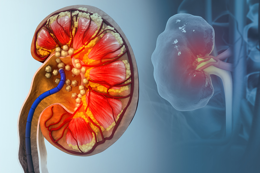 Best-Ayurvedic-Treatment-for-Kidney-Stones-Without-Surgery