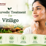 Ayurvedic Treatment for Vitiligo in Bangalore | Ayurhealing